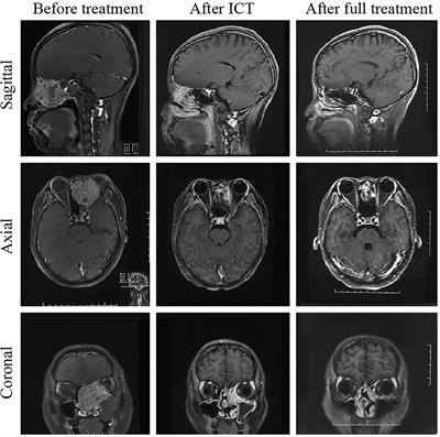 Multimodal Treatment With Orbital Organ Preservation in Adult Patients With Locally Advanced Small-Round-Cell Malignancy of the Nasal Cavity and Paranasal Sinus